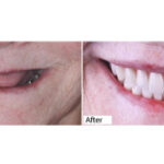 Happy Patient After Dental Implants in Mexico