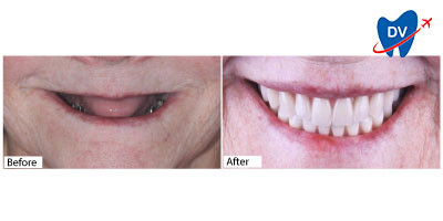 Happy Patient After Dental Implants in Mexico