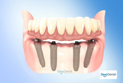 All-on-4 Dental Implants in Mexico Lower jaw