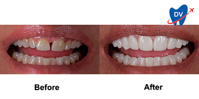 Emax Veneers in Mexico | Before &amp; After