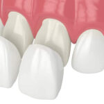 Composite Veneers in Mexico