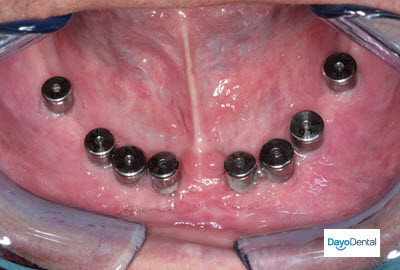 Fixed Bridge with 8 implants secured with implants in Mexico