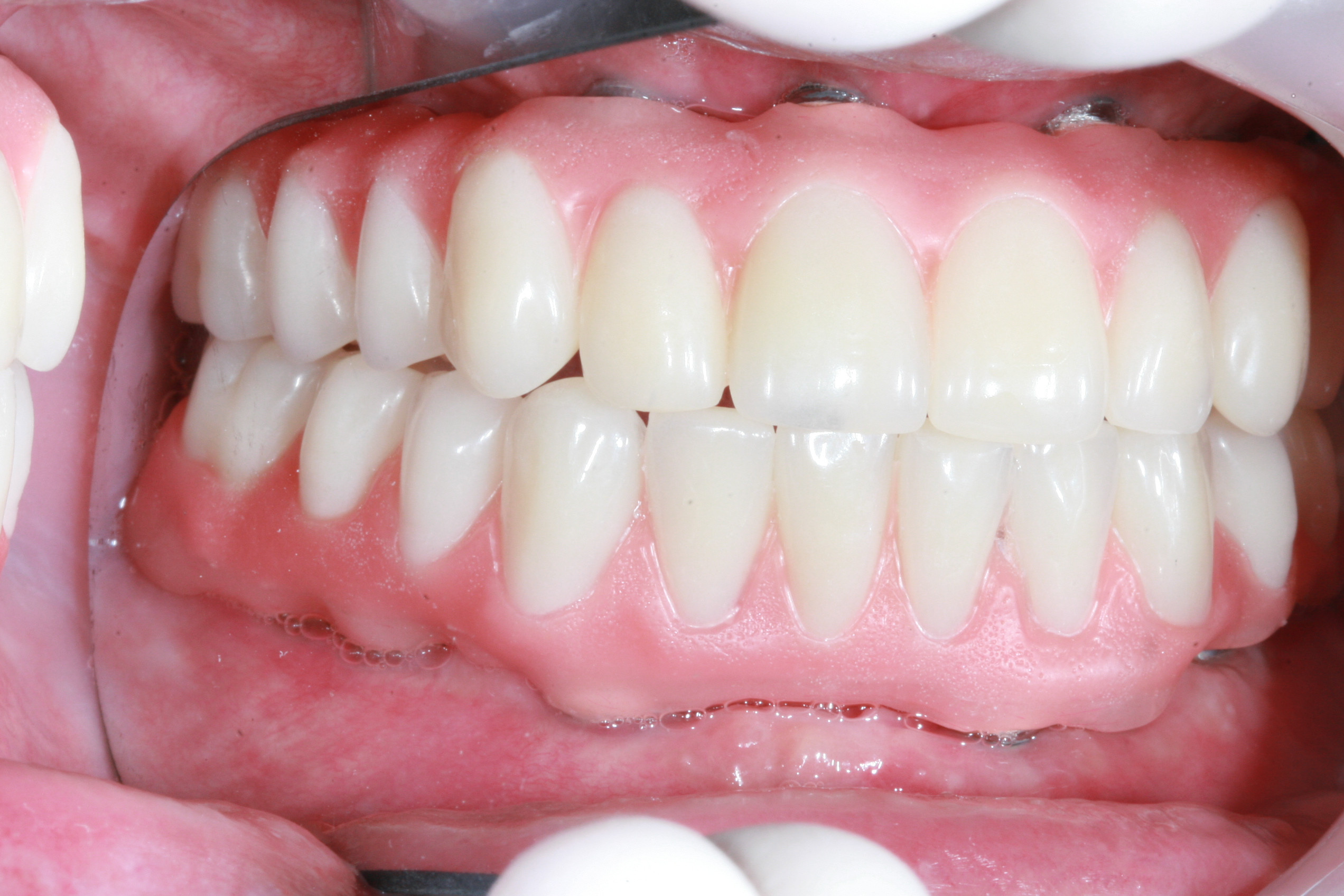 Smiling man after dental implant procedure