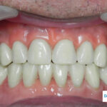 Implant Dentures secured with implants in Mexico