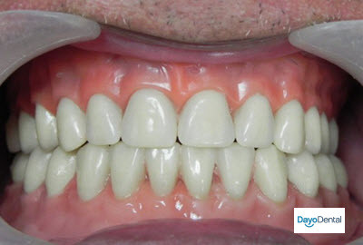 Implant Dentures secured with implants in Mexico