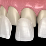 Porcelain Veneers in Mexico