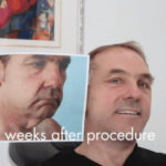 Mini Facelift Incision Points