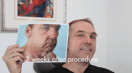 Mini Facelift Incision Points