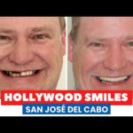 Smile Design with Veneers in Mexico