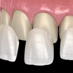 Porcelain Veneers in Mexico