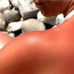 Tourist with Sunburn on Isla Mujeres