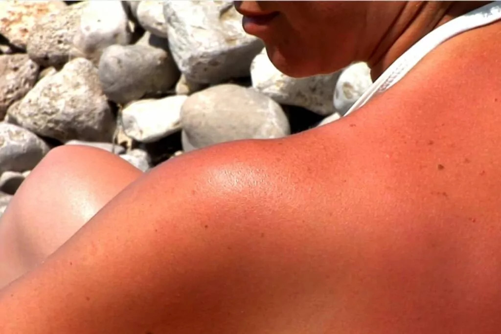 Tourist with Sunburn on Isla Mujeres